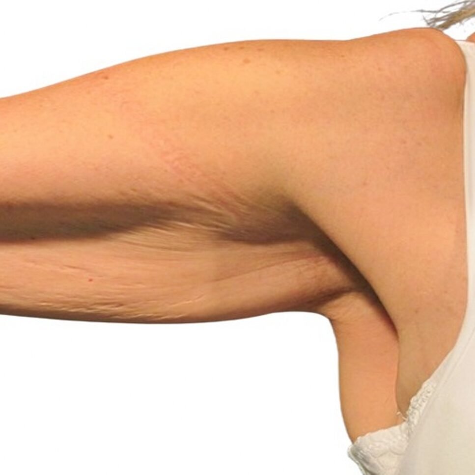 Braccio con pelle flaccida e segni