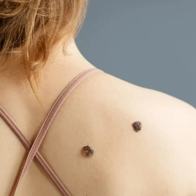 imperferzioni della pelle