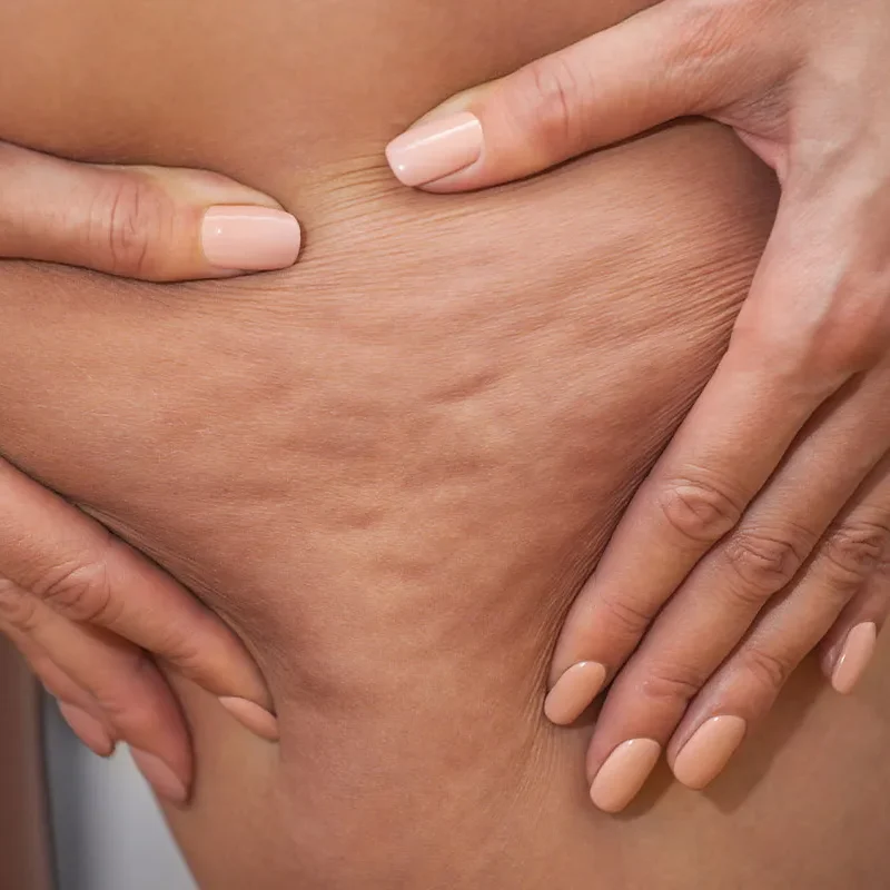 Pelle con cellulite e mani sopra